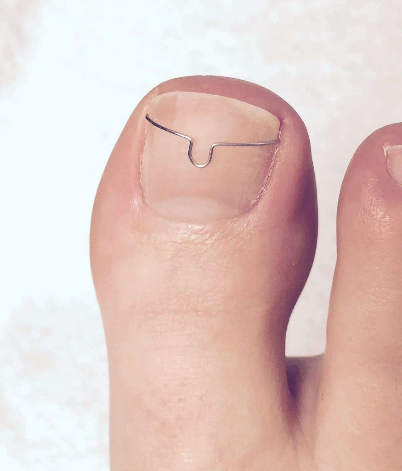 Nedgroede negle - Kan rettes op bøjlebehandling